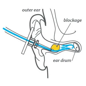 Equadose® HEAR Earwax Removal Kit